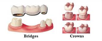 crown and bridges dentist in malviya nagar, jaipur