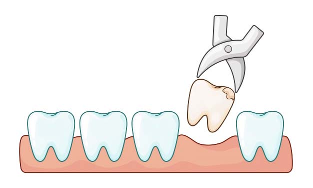 dental extraction clinic in malviya nagar