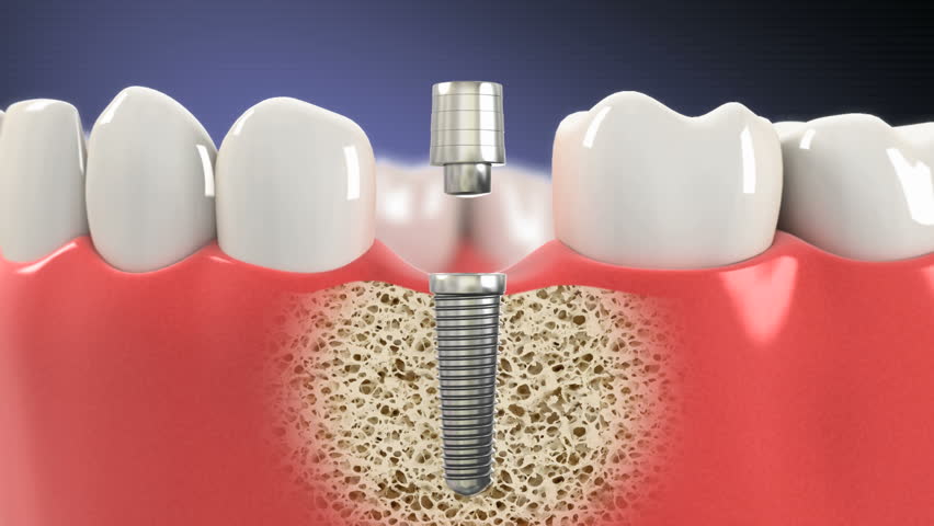 dental implant treatment in jaipur