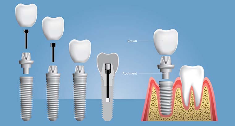 dental implant