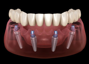 dental implant malviya nagar
