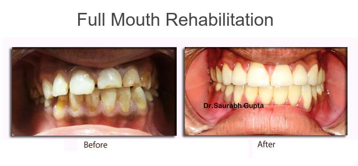 full mouth rehabilitation