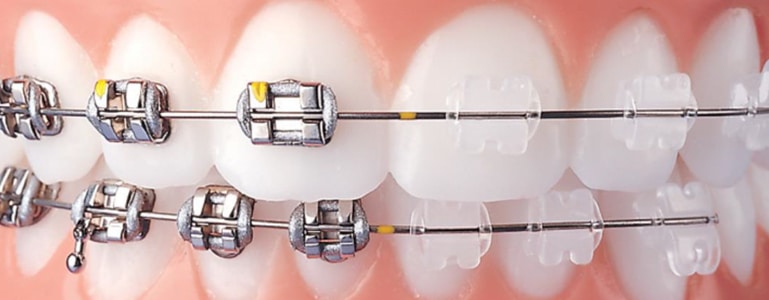 orthodontic treatment in malviya nagar, jaipur