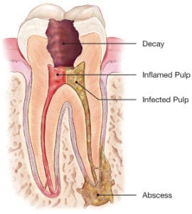 root canal treatment in jaipur